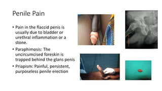 Penile Pain
• Pain in the flaccid penis is
usually due to bladder or
urethral inflammation or a
stone.
• Paraphimosis: The
uncircumcised foreskin is
trapped behind the glans penis
• Priapism: Painful, persistent,
purposeless penile erection
 