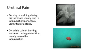 Urethral Pain
• Burning or scalding during
micturition is usually due to
inflammation(gonococcal
urethritis) or a stone.
• Dysuria is pain or burning
sensation during micturition
usually caused by
inflammation.
 