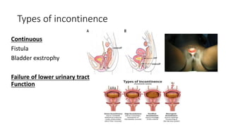Types of incontinence
Continuous
Fistula
Bladder exstrophy
Failure of lower urinary tract
Function
 