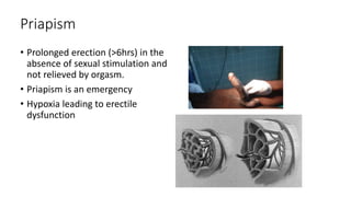 Priapism
• Prolonged erection (>6hrs) in the
absence of sexual stimulation and
not relieved by orgasm.
• Priapism is an emergency
• Hypoxia leading to erectile
dysfunction
 