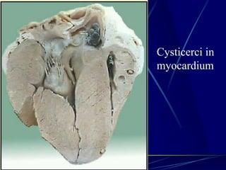 Cysticerci in
myocardium
 
