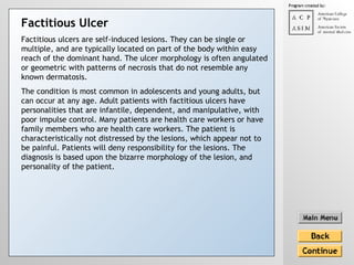 Factitious ulcers are self-induced lesions. They can be single or multiple, and are typically located on part of the body within easy reach of the dominant hand. The ulcer morphology is often angulated or geometric with patterns of necrosis that do not resemble any known dermatosis. The condition is most common in adolescents and young adults, but can occur at any age. Adult patients with factitious ulcers have personalities that are infantile, dependent, and manipulative, with poor impulse control. Many patients are health care workers or have family members who are health care workers. The patient is characteristically not distressed by the lesions, which appear not to be painful. Patients will deny responsibility for the lesions. The diagnosis is based upon the bizarre morphology of the lesion, and personality of the patient. Factitious Ulcer 