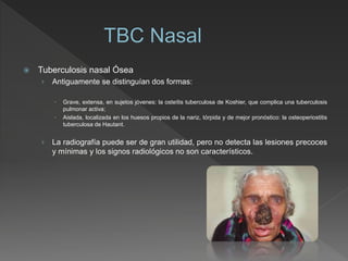  Tuberculosis nasal Ósea
› Antiguamente se distinguían dos formas:
 Grave, extensa, en sujetos jóvenes: la osteítis tuberculosa de Koshier, que complica una tuberculosis
pulmonar activa;
 Aislada, localizada en los huesos propios de la nariz, tórpida y de mejor pronóstico: la osteoperiostitis
tuberculosa de Hautant.
› La radiografía puede ser de gran utilidad, pero no detecta las lesiones precoces
y mínimas y los signos radiológicos no son característicos.
 