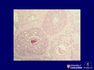 tumor - DEFINITION AND DESCRIPTON