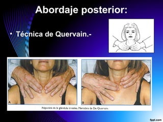 Abordaje posterior:
• Técnica de Quervain.-
 
