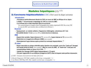 Syndrome de Budd-Chiari (SBC)
Nodules hépatiques (2/2) 1) 2)
2) Carcinome hépatocellulaire (CHC) (Voir aussi la diapo suivante)
Introduction
Introduction
- Prévalence particulièrement élevée du CHC au cours du SBC en Afrique et au Japon.
- L'EASL a) recommande le dépistage du CHC au cours du SBC.
- La cirrhose est un état important dans sa survenue.
Les caractéristiques en imagerie (dont l'échographie) des nodules régénératifs HNF-like et des CHC
au cours du SBC sont résumées dans un tableau de la référence 1.
Scanner
- Typiquement: un nodule solitaire, d'apparence hétérogène, volumineux (5-7 cm)
- Sensibilité élevée > 2 cm (environ 90%), moins bonne en dessous.
IRM
- Aspect très variable. Hypo-intense en T1: environ 60%, hyper-intense en T2: environ 60%
- Restriction en imagerie de diffusion (DWI) (non constant)
- Généralement hypo-intense après produit de contraste hépato-biliaire. 2)
À noter:
- Hyper-vasculaire en phase artérielle après injection de contraste, suivi d'un "wah-out" (lavage)
aux temps portal et tardif. (non constant). Mais au cours du SBC, le "wash-out" n'est pas une
caractéristique fiable en faveur d'un CHC. 2)
- Intérêt d'un dosage d'AFP (alpha foetoprotéine) > 15 ng/ml.
- On peut rapprocher la surveillance (imagerie et AFP) mais la biopsie reste parfois nécessaire.
a) EASL = European Association for the Study of the Liver.
1) Rizzetto Diagnostics 2023 (Réf. complète en fin de topo, iconographie ++)
2) van Wettere JHEP/Rep 2020 (Réf. complète en fin de topo, iconographie ++)
Claude EUGÈNE 25
 