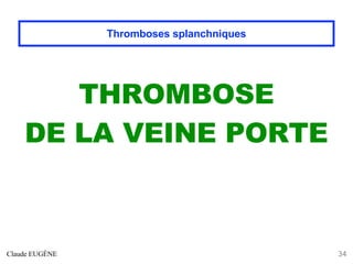 THROMBOSE
DE LA VEINE PORTE
Claude EUGÈNE 34
Thromboses splanchniques
 