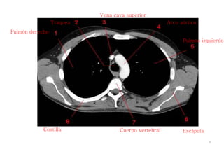 Pulmón derecho
Tráquea
Vena cava superior
Arco aórtico
Pulmón izquierdo
EscápulaCuerpo vertebralCostilla
7
 