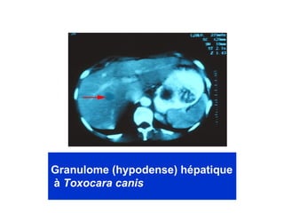 Granulome (hypodense) hépatique
à Toxocara canis
 