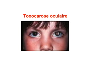 Toxocarose oculaire
 
