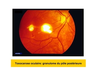 Toxocarose oculaire: granulome du pôle postérieure
 