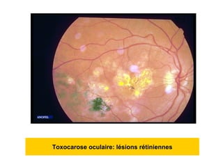 Toxocarose oculaire: lésions rétiniennes
 