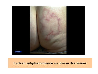 Larbish ankylostomienne au niveau des fesses
 