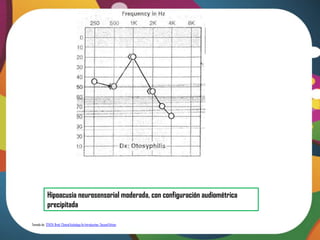 Hipoacusia neurosensorial moderada, con configuración audiométrica
             precipitada

Tomado de: STACH, Brad. Clinical Audiology An Introduction. Second Edition
 