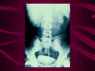 Tuberculosis 1