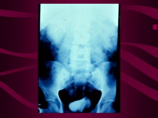 Tuberculosis 1