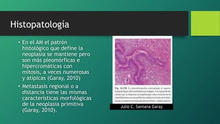 • En el AM el patrón
histológico que define la
neoplasia se mantiene pero
son más pleomórficas e
hipercromáticas con
mitosis, a veces numerosas
y atípicas (Garay, 2010)
• Metastasis regional o a
distancia tiene las mismas
características morfológicas
de la neoplasia primitiva
(Garay, 2010).
Julio C. Santana Garay
Histopatología
 