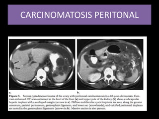 CARCINOMATOSIS PERITONAL
 