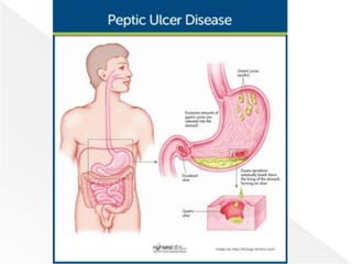 Unit 1; Gastro-Intestinal Disorders (1).pptx