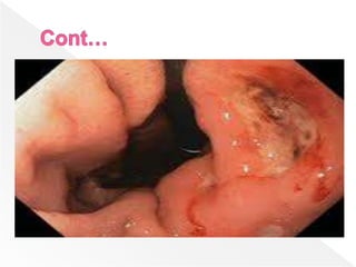 Unit 1; Gastro-Intestinal Disorders (1).pptx