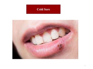 11
Cold Sore
 
