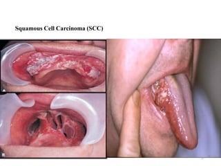 25
Squamous Cell Carcinoma (SCC)
 