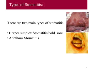 Types of Stomatitis:
There are two main types of stomatitis
•Herpes simplex Stomatitis/cold sore
•Aphthous Stomatitis
9
 