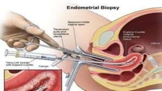 Uterine  polyps
