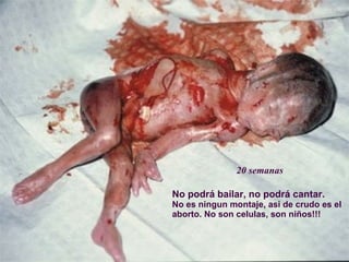 20 semanas No podrá bailar, no podrá cantar. No es ningun montaje, asi de crudo es el aborto. No son celulas, son niños!!! 