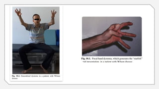 wilsons disease (movement disorder) 