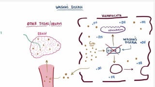 wilsons disease (movement disorder) 